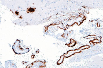 Image: Micrograph showing amyloid-beta (brown) in senile plaques of the cerebral cortex (upper left of image) and cerebral blood vessels (right of image) with immunostaining (Photo courtesy of Wikimedia Commons).