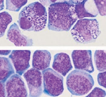 Image: Acute myeloid leukemia cells presenting anomalies in standard growth conditions (top). Acute myeloid leukemia cells preserving their leukemic cell features following in vitro culture with the two chemical molecules referred to in the study (below) (Photo courtesy of the Université de Montréal).