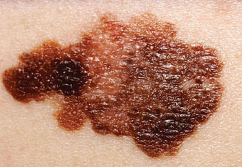Image: A melanoma on a patient\'s skin (Photo courtesy of the US National Cancer Institute).