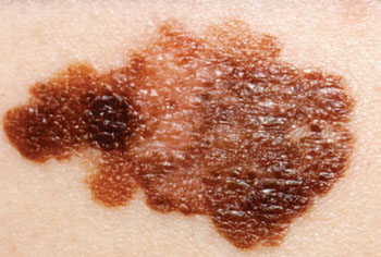 Image: Melanoma on a patient\'s skin (Photo courtesy of the [US] National Cancer Institute).