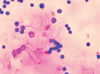 Image: Cytology of pericardial fluid showing abundant, rectangular crystals corresponding to cholesterol crystals and inflammatory cells consisting of lymphocytes and macrophages (Photo courtesy of Dr. Mercedes Camprubí).