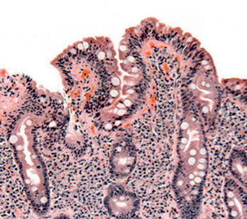 Image: Biopsy of small bowel showing celiac disease manifested by blunting of villi, crypt hyperplasia, and lymphocyte infiltration of crypts (Photo courtesy of Wikimedia Commons).