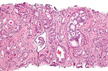 Image: Micrograph showing prostatic acinar adenocarcinoma, the most common form of prostate cancer (Photo courtesy of Zephron).