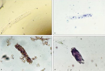 Image: Urinary Casts as viewed by microscopy (A) Hyaline cast (×200); (B) erythrocyte cast (×100 ); (C) leukocyte cast (×100) ; (D) granular cast (×100) (Photo courtesy of the American Family Physician).