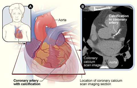 Image: Figure A shows the location and angle of the coronary calcium scan image. Figure B is a coronary calcium scan image showing calcifications in a coronary artery (Photo courtesy of the [US] National Heart, Lung, and Blood Institute).