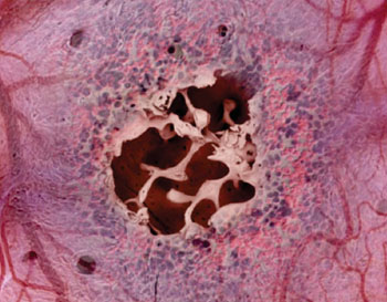Image: Microscopic view of the engineered bone with an opening exposing the internal trabecular bony network, overlaid with colored images of blood cells and a supportive vascular network that fills the open spaces in the bone marrow-on-a-chip (Photo courtesy of James Weaver, Harvard’s Wyss Institute).