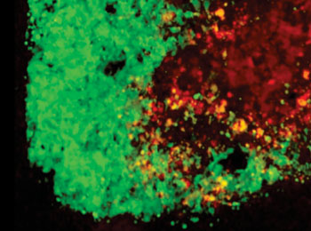 Image: Stem cells loaded with cancer-killing herpes virus attack a brain tumor cell. Tumor cells in green. oHSV-loaded stem cells in red. oHSV-infected tumor cells in yellow (Photo courtesy of Dr. Khalid Shah, Harvard University).