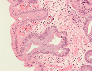 Image: Photomicrograph of the metaplasic epithelium of Barrett\'s esophagus which is characterized by goblet cell (Photo courtesy of Nephron).