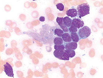 Image: Photomicrograph from a bone marrow aspirate of a cluster of neuroblastoma cells forming the so-called neuroblastoma rosette, typical for this tumor (Photo courtesy of Luhan Swart).