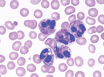 Image: Blood film showing five active eosinophils with a multisegmented nucleus and numerous eosinophilic granules (Photo courtesy of American Academy of Pediatrics).