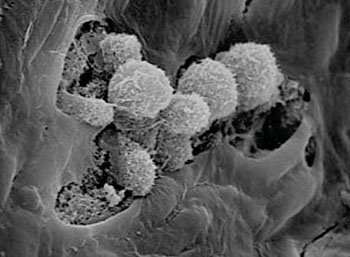 Image: Scanning electron micrograph of human papillomavirus (HPV) (Photo courtesy of University of Washington).