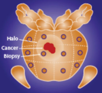 Image: ConfirmMDx detects an epigenetic field effect or “halo” associated with the cancerization process at the DNA level in cells adjacent to cancer foci. This epigenetic “halo” around a cancer lesion can be present despite having a normal appearance under the microscope (Photo courtesy of MDxHealth).