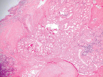 Image: Histopathology of chronic obstructive pulmonary disease (COPD) showing hyperplasia of mucous glands and infiltration of the airway wall with inflammatory cells (Photo courtesy of Dr. Paul Kleinschmidt MD).