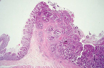 Image: Histopathology of a colon with adenocarcinoma showing chaotic appearance of glandular pattern (Photo courtesy of Johns Hopkins University).