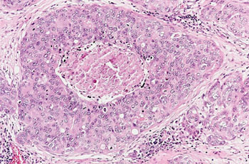 Image: Histopathology of mammary tissue, high grade breast cancer (Photo courtesy of Johns Hopkins Medicine).
