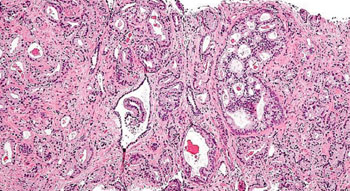 Image: Histopathology micrograph of prostatic acinar adenocarcinoma, the most common form of prostate cancer (Photo courtesy of Nephron).