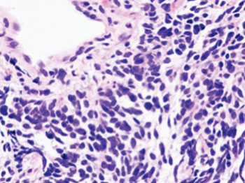 Image: Histopathologic image of small-cell lung cancer (Photo courtesy of Wikimedia Commons).
