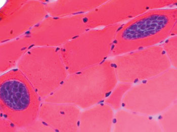 Image: Sarcocysts of Sarcocystis spp. in muscle tissue, stained with hematoxylin and eosin (Photo courtesy of the William Beaumont Hospital).