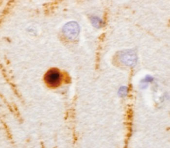 Image: Lewy body (brown) from the brain of a Parkinson\'s disease patient (Photo courtesy of the University of Pennsylvania).