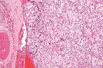 Image:  A photomicrograph of a paraganglioma, a carotid body tumor (Photo courtesy of Nephron).