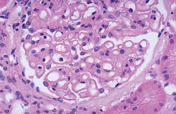 Image: Histopathology of a kidney showing membranous glomerulonephritis (Photo courtesy of University of Utah).