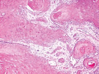 Image: Histology of squamous cell carcinoma of the bladder (Photo courtesy of British Columbia Cancer Agency).