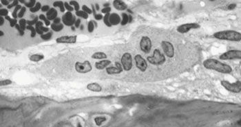 Image: Osteoclast, with bone below it, shows typical distinguishing characteristics: a large cell with multiple nuclei and a “foamy” cytosol (Photo courtesy of Wikimedia Commons).