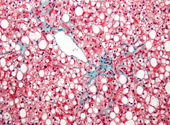 Image: Histopathology of non-alcoholic fatty liver disease showing the liver with prominent macrovesicular steatosis (Photo courtesy of Nephron).