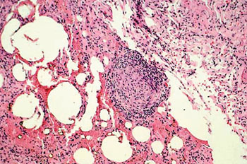 Image: Histology of lung tissue from a chronic beryllium disease patient showing granulomatous tissue (Photo courtesy of the Cleveland Clinic).