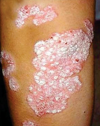 Image: Large plaque psoriasis of the limbs (Photo courtesy of the American Academy of Dermatology).