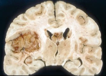 Image: Glioblastoma multiforme (GBM) (Photo courtesy of the University of California, San Diego School of Medicine).