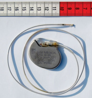 Image: This type of electronic pacemaker could become obsolete if induction of biological pacemaker cells by gene therapy proves successful (Photo courtesy of Wikimedia Commons).