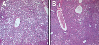 Image: In the liver tissue of obese animals with type II diabetes, unhealthy, fat-filled cells are prolific (small white cells, panel A). After chronic treatment through FGF1 injections, the liver cells successfully lose fat and absorb sugar from the bloodstream (small purple cells, panel B) and more closely resemble cells of normal, non-diabetic animals (Photo courtesy of the Salk Institute for Biological Studies).