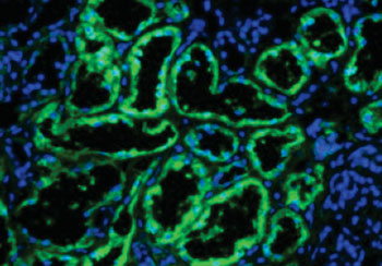 Image: A metabolic enzyme has an unexpected role in regulating gene expression in kidney cancer. Primary human kidney tissue: FBP1 protein (green); cell nuclei (blue) (Photo courtesy of the University of Pennsylvania).