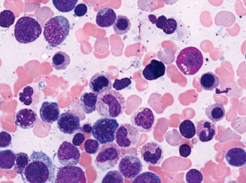 B Image: Bone marrow aspirate smear from a patient with myelodysplastic syndromes (Photo courtesy of Dr. Robert P Hasserjian, MD).
