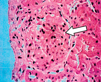 Image: Histopathology of a child’s kidney showing one glomerulus (arrow) with matrix expansion and uniform thickening of the basement membrane. The tubules show mild atrophy and the interstitium contains patchy moderate infiltrates. The appearance is consistent with membranous nephropathy (Photo courtesy of Dr. S. K. Pradhan).