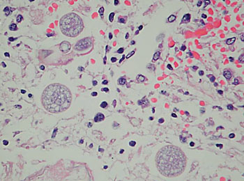 Image: Photomicrograph of Coccidioides immitis in lung tissue showing as large, irregularly sized thick walled spherules (Photo courtesy of Dr. William McDonald, MD).
