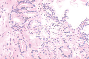 Image: The photomicrograph shows the appearance of a low grade carcinoma of the prostate that can be difficult to recognize as malignancy, particularly in small needle biopsies (Photo courtesy of the University of Washington).