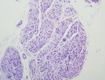 Image: Histology of amyotrophic lateral sclerosis showing markedly degenerated anterior spinal nerve root (cross section) with extensive demyelination (Photo courtesy of Dr. Hidehiro Takei, MD).