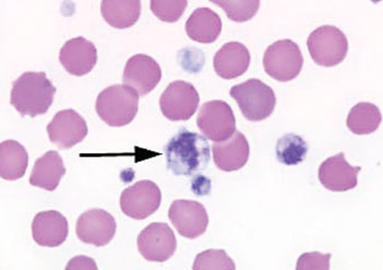 Image: Photomicrograph of a blood smear showing a giant platelet (arrowed) from a patient with hemorrhagiparous thrombocytic dystrophy (Photo courtesy of the College of American Pathologists).