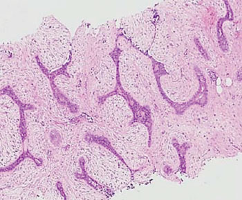 Image: Histopathological image of breast fibroadenoma from a core needle biopsy (Photo courtesy of Dr. Jeremy Thomas).