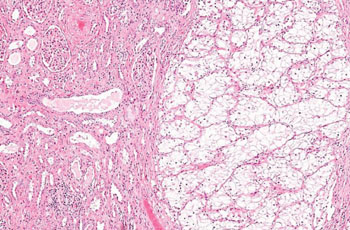 Image: Histopathology of clear cell renal cell carcinoma (Photo courtesy of Nephron).