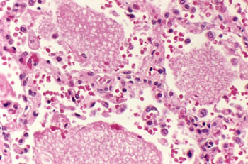Image: Histopathology of a lung showing alveolar spaces containing exudates characteristic of infection with Pneumocystis jirovecii (Photo courtesy of Dr. Edwin P. Ewing, Jr).