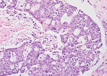 Image: Histopathology of high-grade serous ovarian carcinoma (Photo courtesy of Dr. Ed Uthman, MD).