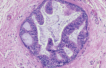 Image: Histopathology of non-comedo breast intraductal carcinoma showing distended duct with intact basement membrane, micropapillary, and early cribriform growth pattern (Photo courtesy of Dr. Rachel Swart, MD, PhD).