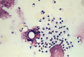 Image: Leishmania amastigotes from a smear of a patient with cutaneous leishmaniasis (Photo courtesy of University of California, Los Angeles).