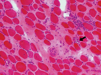 Image: Histopathology of increased endomysial connective tissue from a patient with Duchenne Muscular Dystrophy. Necrotic fibers arrowed (Photo courtesy of Washington University in St. Louis).