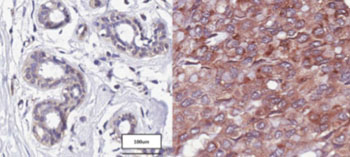 Image: Difference in DP103 (red) levels in a healthy person (left image) and a breast cancer patient (right image) (Photo courtesy of the National University of Singapore).