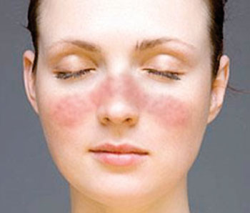 Image: The characteristic Malar rash or butterfly rash seen in a patient with systemic lupus erythematosus (Photo courtesy of the National Institute of Arthritis and Musculoskeletal and Skin Diseases).