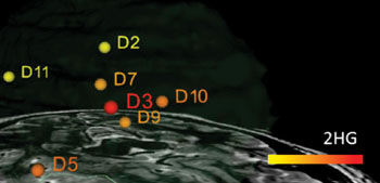 Image: Superimposed on an MRI image of the tumor, the DESI-MS system shows areas clear of tumor (D11 and D2) as well as the main tumor region with a high level of the tumor metabolite 2-HG (D3.) (Photo courtesy of R. Graham Cooks, Purdue University).